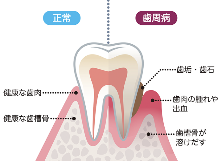 歯周病治療の画像